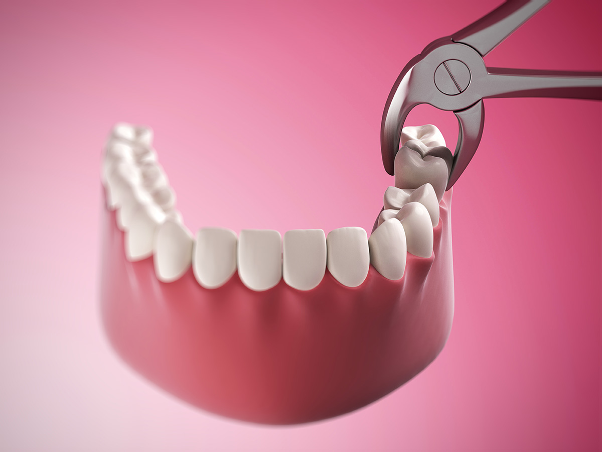 هزینه کشیدن دندان عقل در سال ۹۹ چقدر است دکتر فراز تیموری